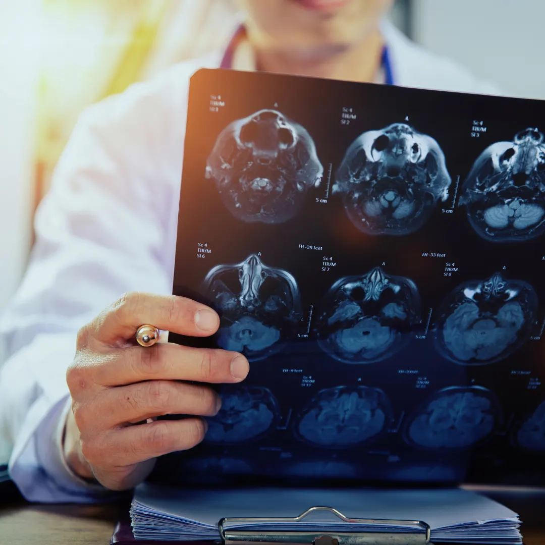 The Relationship Between Football Head Impacts & Neurological Decline