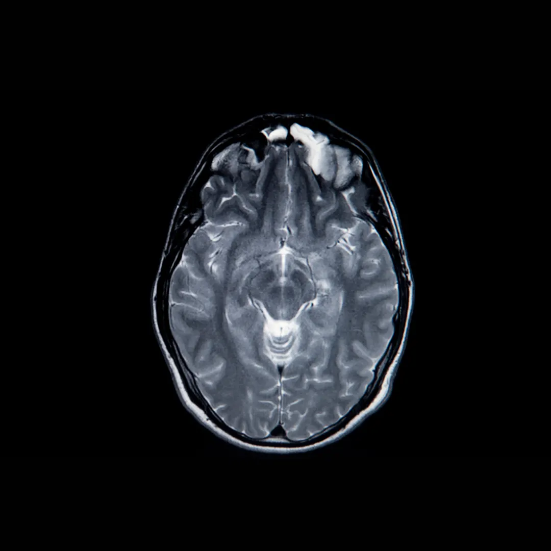 Of 111 NFL Player Brains Analysed, 110 Found to be Damaged